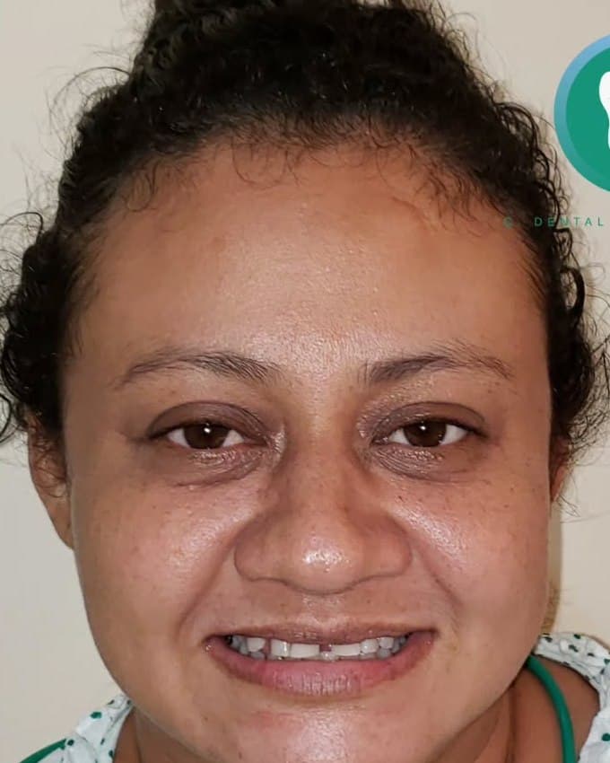 Cierre de diastema y alineación — antes del tratamiento