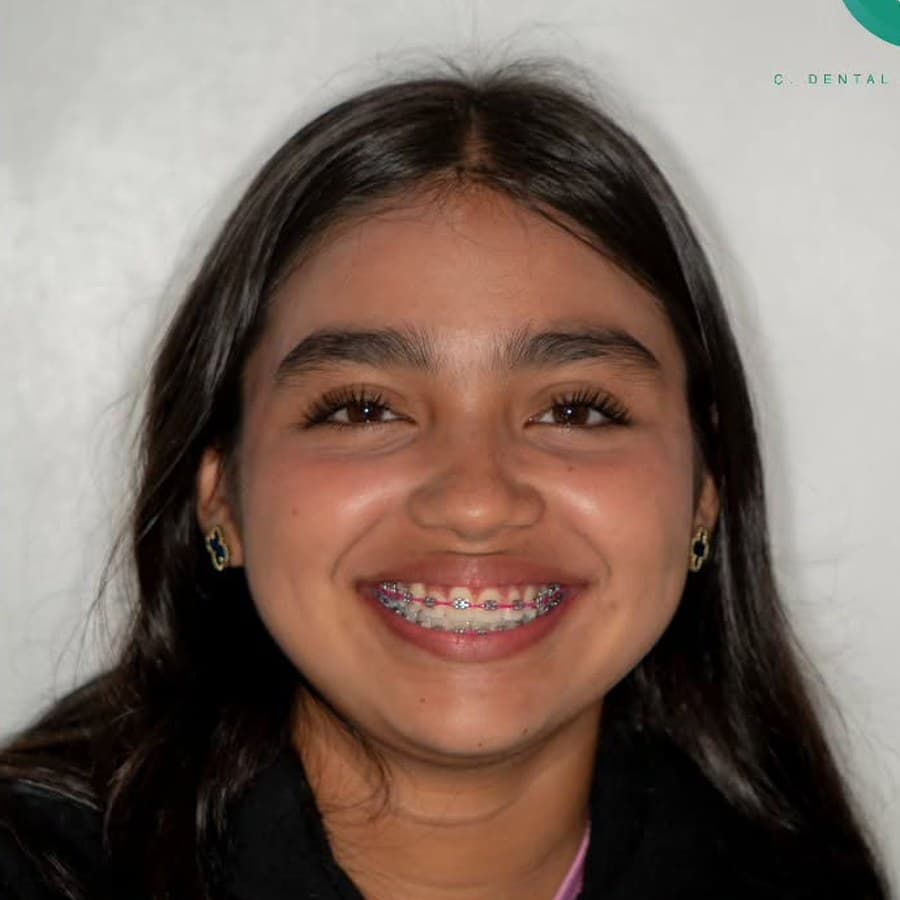 Paciente en tratamiento de ortodoncia con brackets en Clínica Dental Bellas Artes, Chinandega